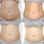Refit by Aesthetic Line Refit