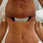Refit by Aesthetic Line Refit